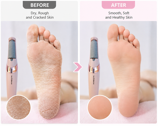 Rechargable Foot Filer Effective Callus Remover For Soft Smooth Feet With Easy